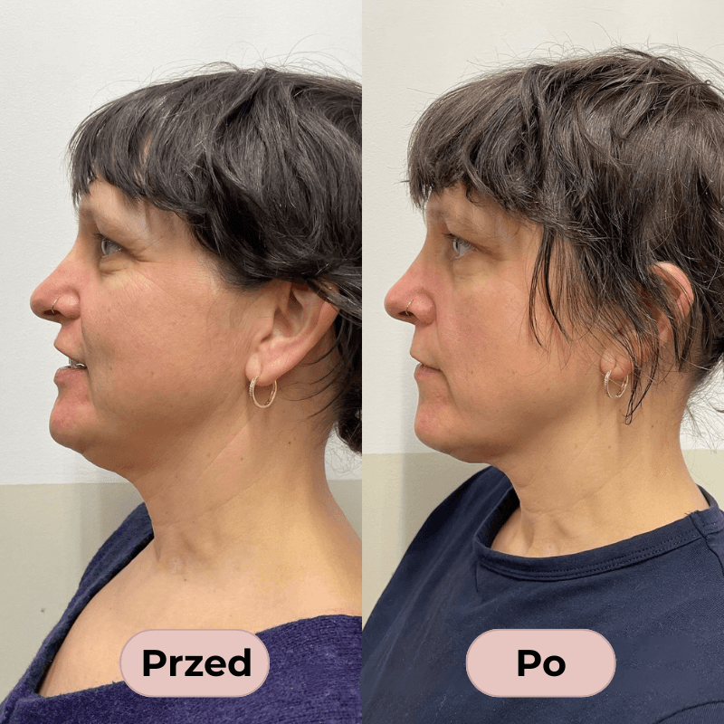 LumiBrush- smuklejsza twarz już po pierwszym użyciu!